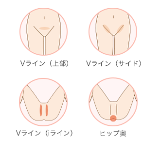 VIO脱毛コースの脱毛可能部位